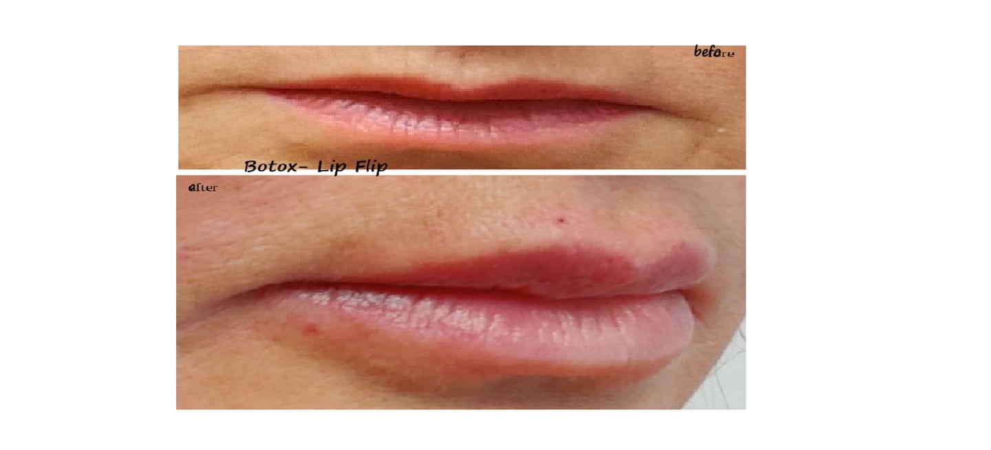Before and after image of botox lip flip – fuller lips and reduced lines around the mouth.