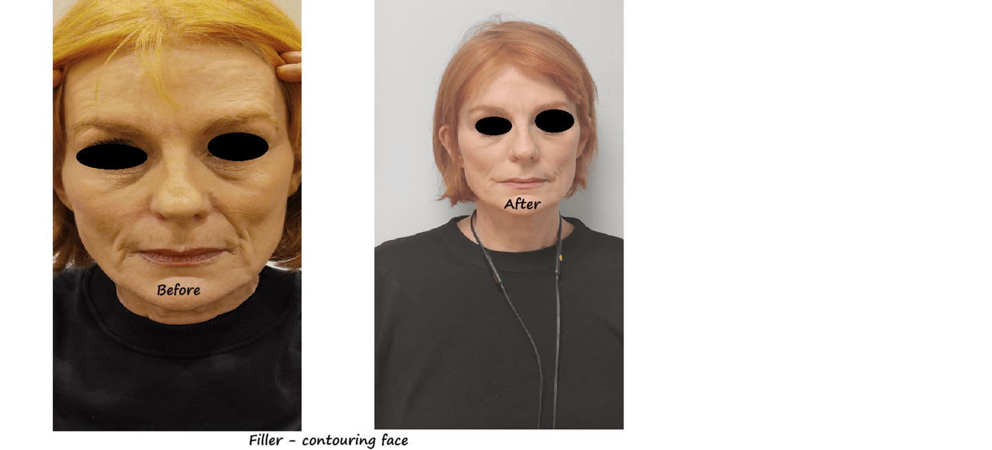 //   Before and after image filler facial contour – restored volume and more harmonious face.