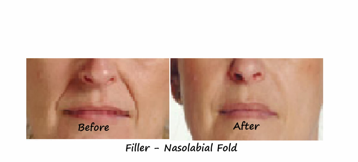 Before and after photos Filler nasolabial folds – smoother contour & younger appearance after filler