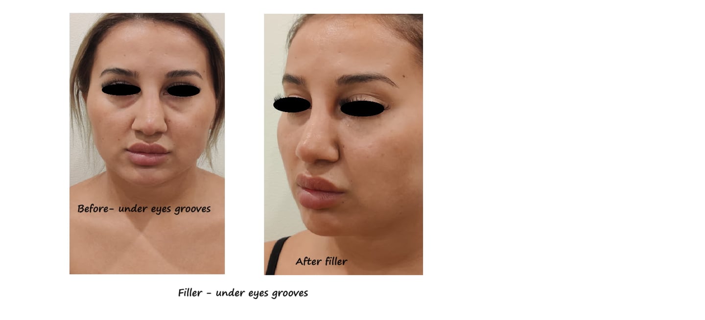 Before & after image filler under the eyes – Reduced dark circles & younger, more vibrant appearance