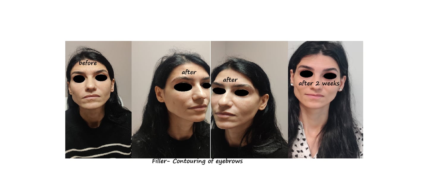 Before and after photos filler eyebrows contour – softer brows, lifted and harmonious face.