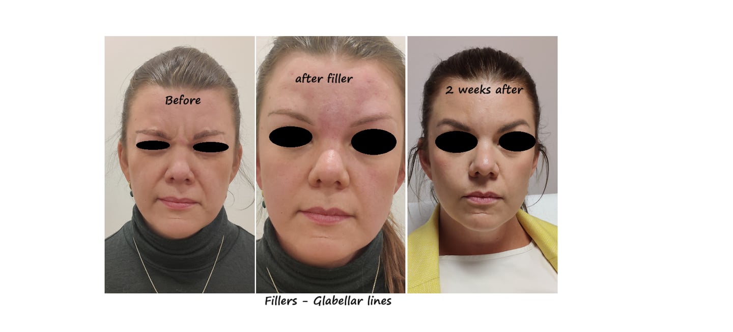 Before and after photos filler glabella – smooth glabella without wrinkles for a pleasant expression