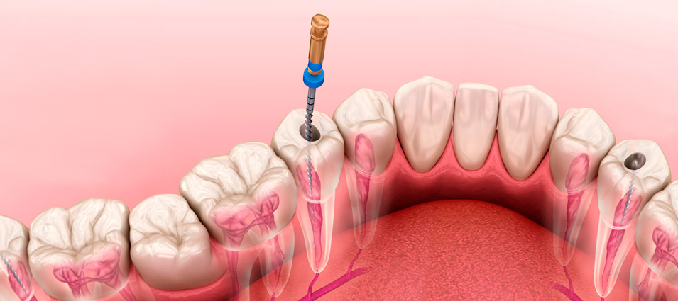 trattamento-endodontico-brescia