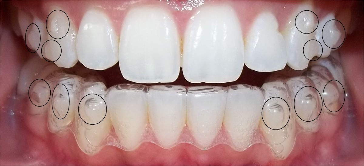 invisalign