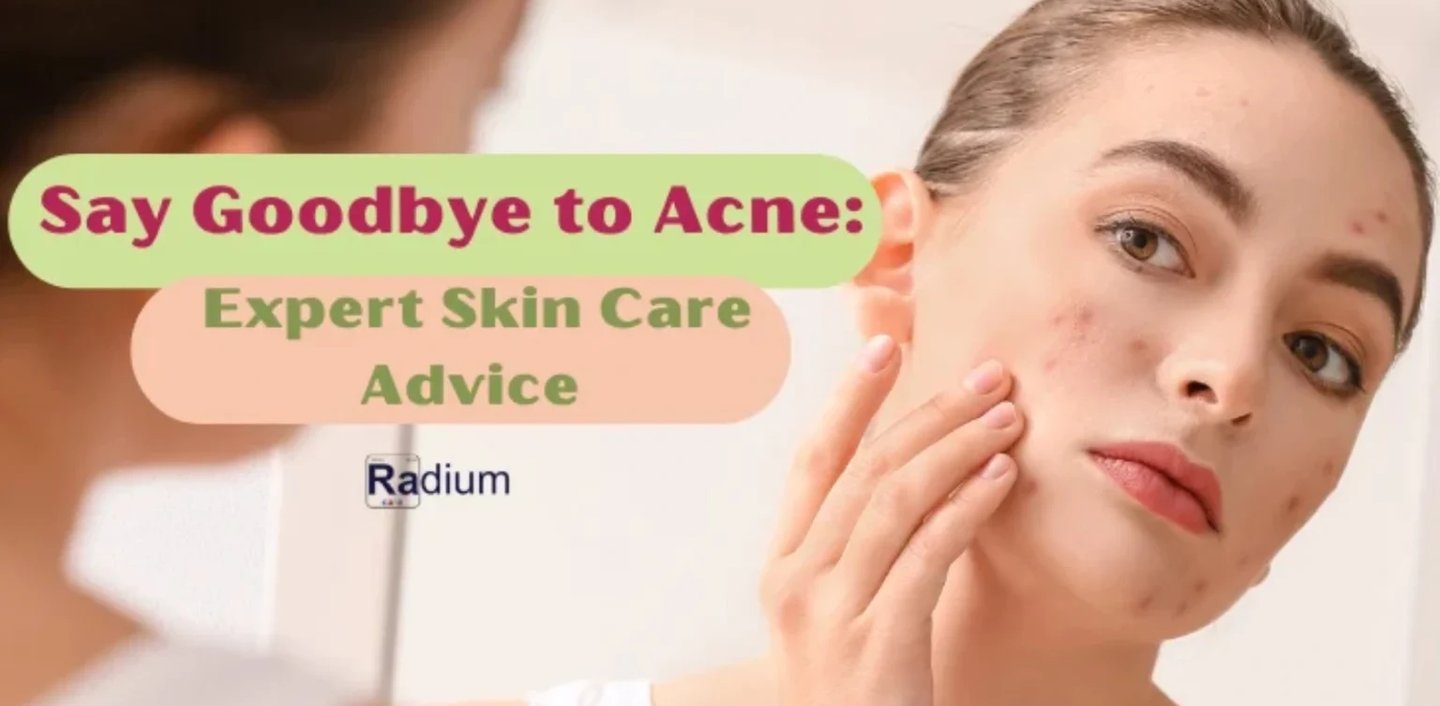 goodbye to acne