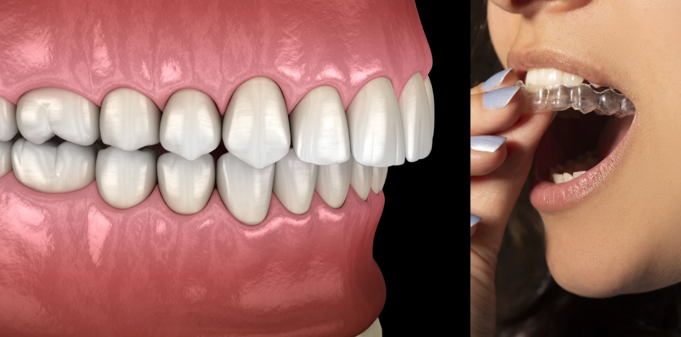 تقويم شفاف بالكويت