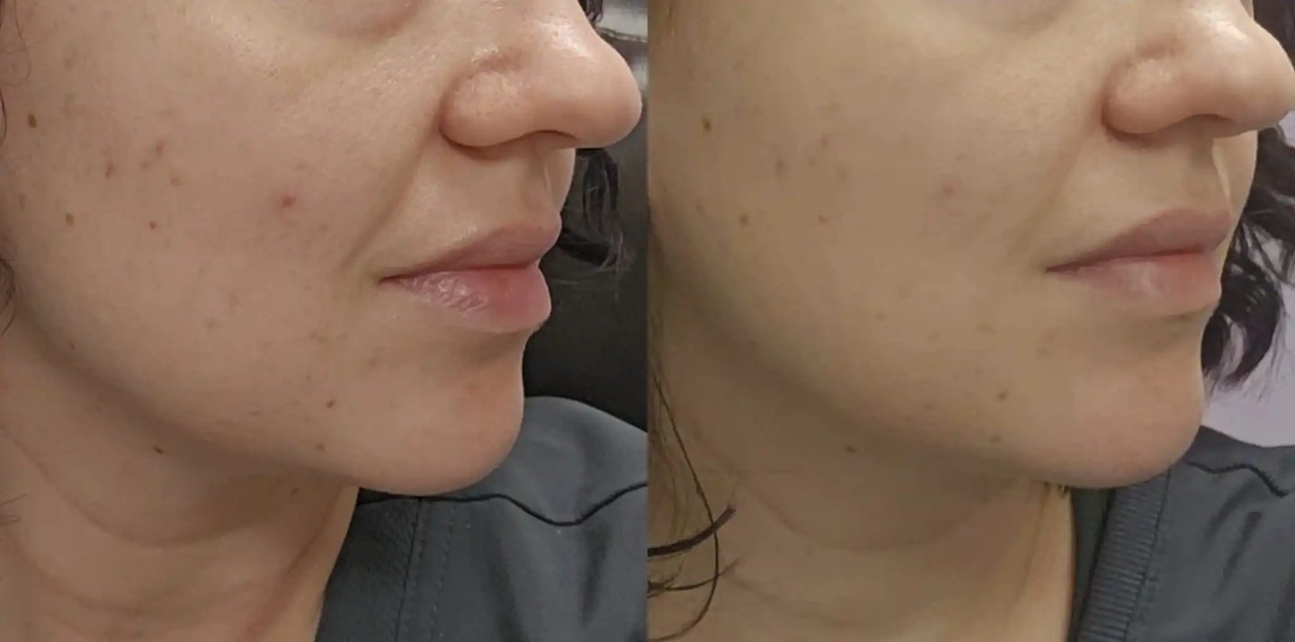 KINVIVE by Juvederm treatment at Ariana Esthetic Edmonton