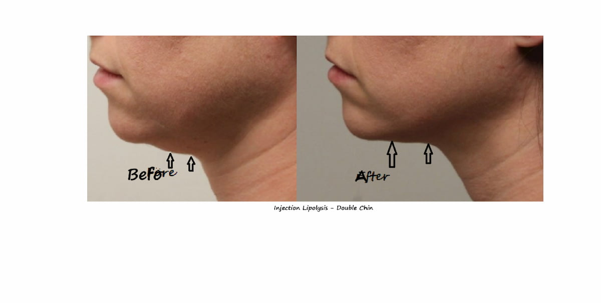 Fat reduction Delhi before and after photo – injection lipolysis double chin, male 20 yrs.