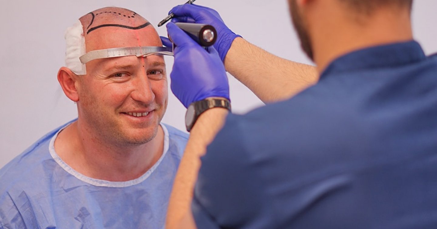 perte de cheveux, chirurgie esthétique, greffe de barbe, تساقط الشعر, زراعة الشعر, علاج الصلع, hair