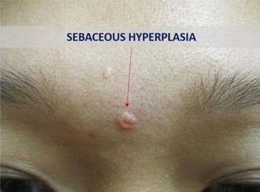 Sebaceous HyperPlasia Removal ReviVe Skin Aesthetic Clinic sebaceous-hyperplasia-removal-revive-skin-aesthetic-clinic