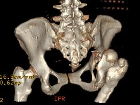 骨盤骨折 = Fractures of the pelvis and acet… Clinical Workflow Algorithm for Preoperative Planning, Reduction