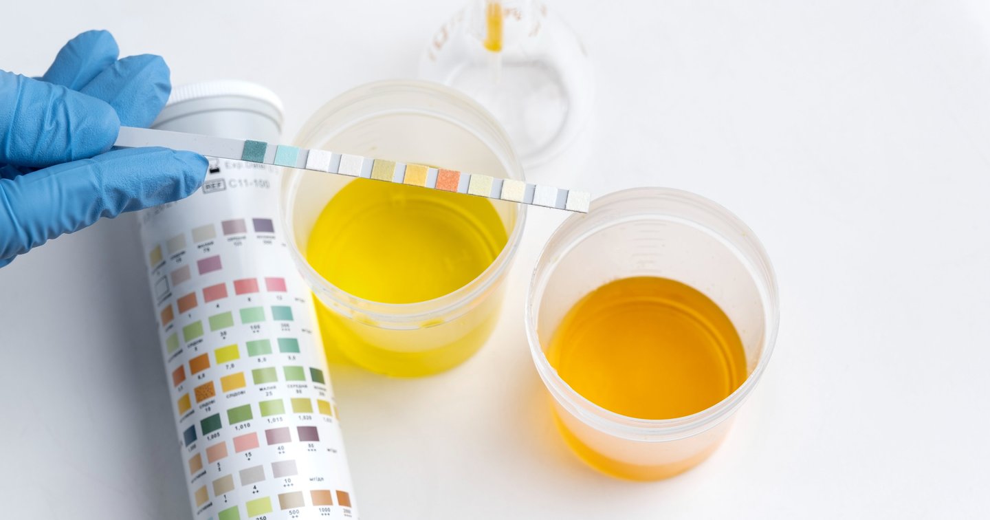 Ką reikia žinoti apie šlapimo rūgšties tyrimus | Euromedika