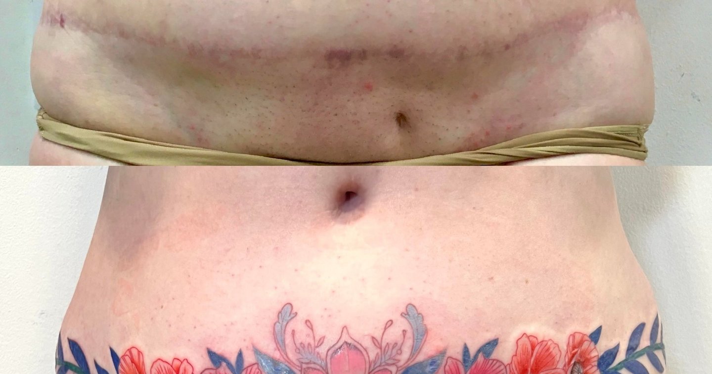 Cicatriz por abdominoplastia. | Secret Tattoo Barcelona, image size:1440x756
