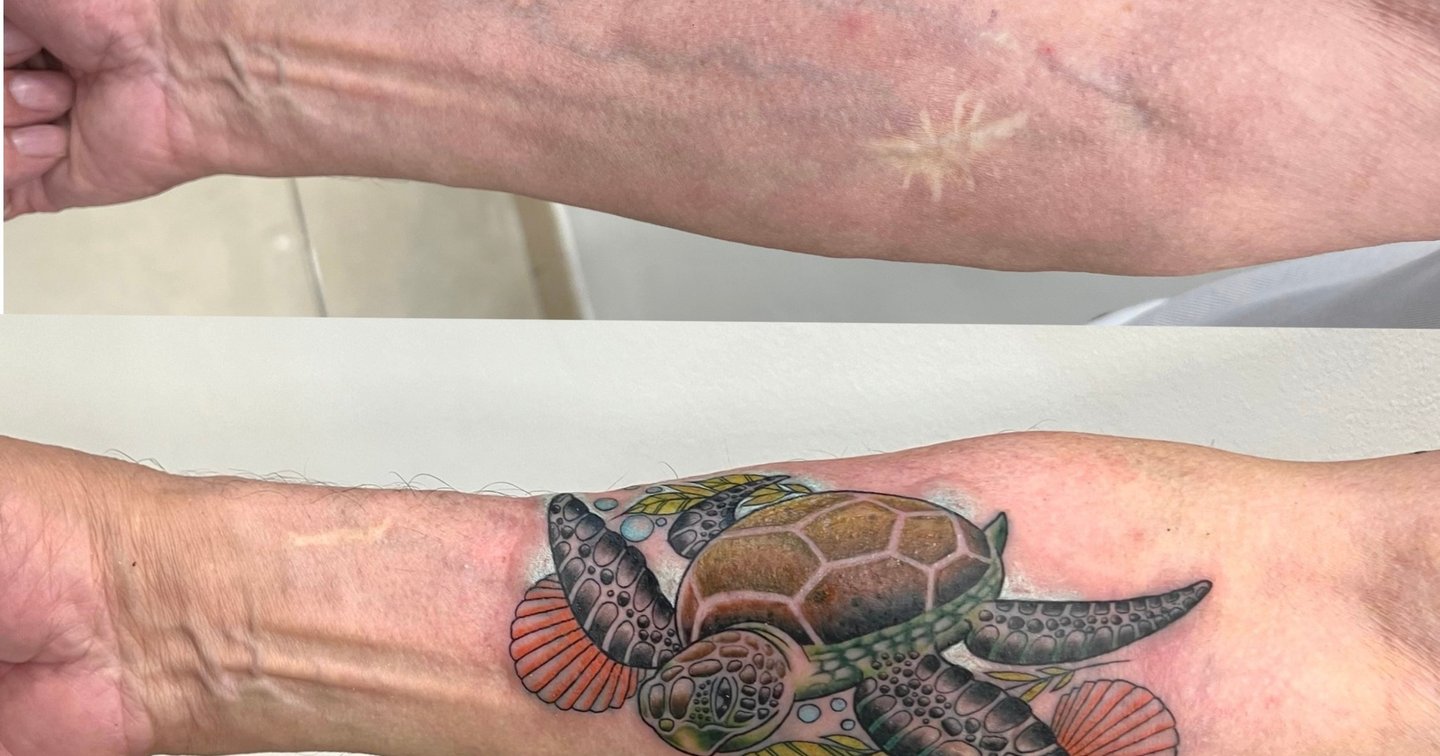 Cómo cubrir cicatrices con tatuajes artísticos en Barcelona | Secret Tattoo  Barcelona, image size:1440x756