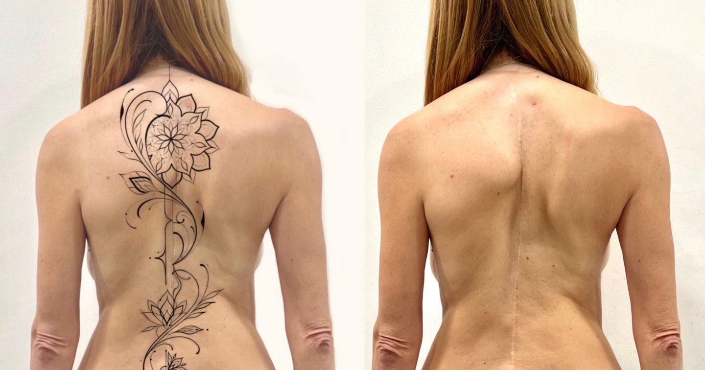 Transforming Scars into Art: The Case of Eli. | Secret Tatto Barcelona, image size:1440x756