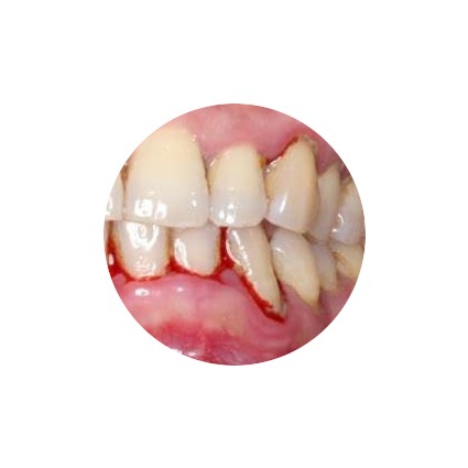 Saignement des gencives : Causes, Traitements et Soins Naturels |  Hygine-Prcision