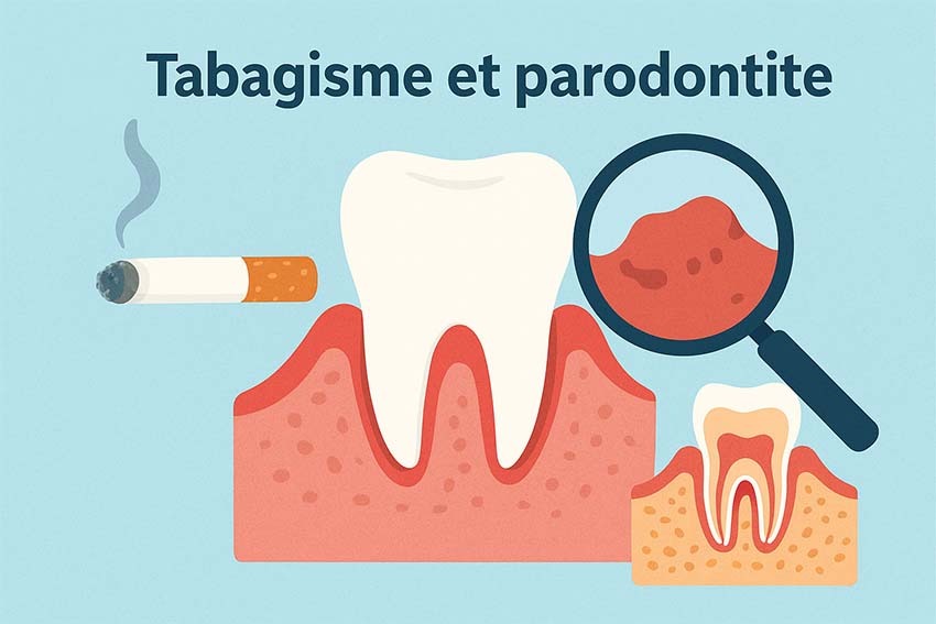 Tabagisme et parodontite : comment le tabac détruit vos gencives