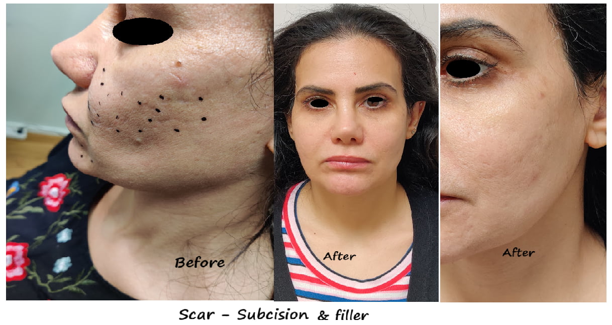 Before and after photos scar treatment with subcision + filler – smoother skin, reduced acne scars.