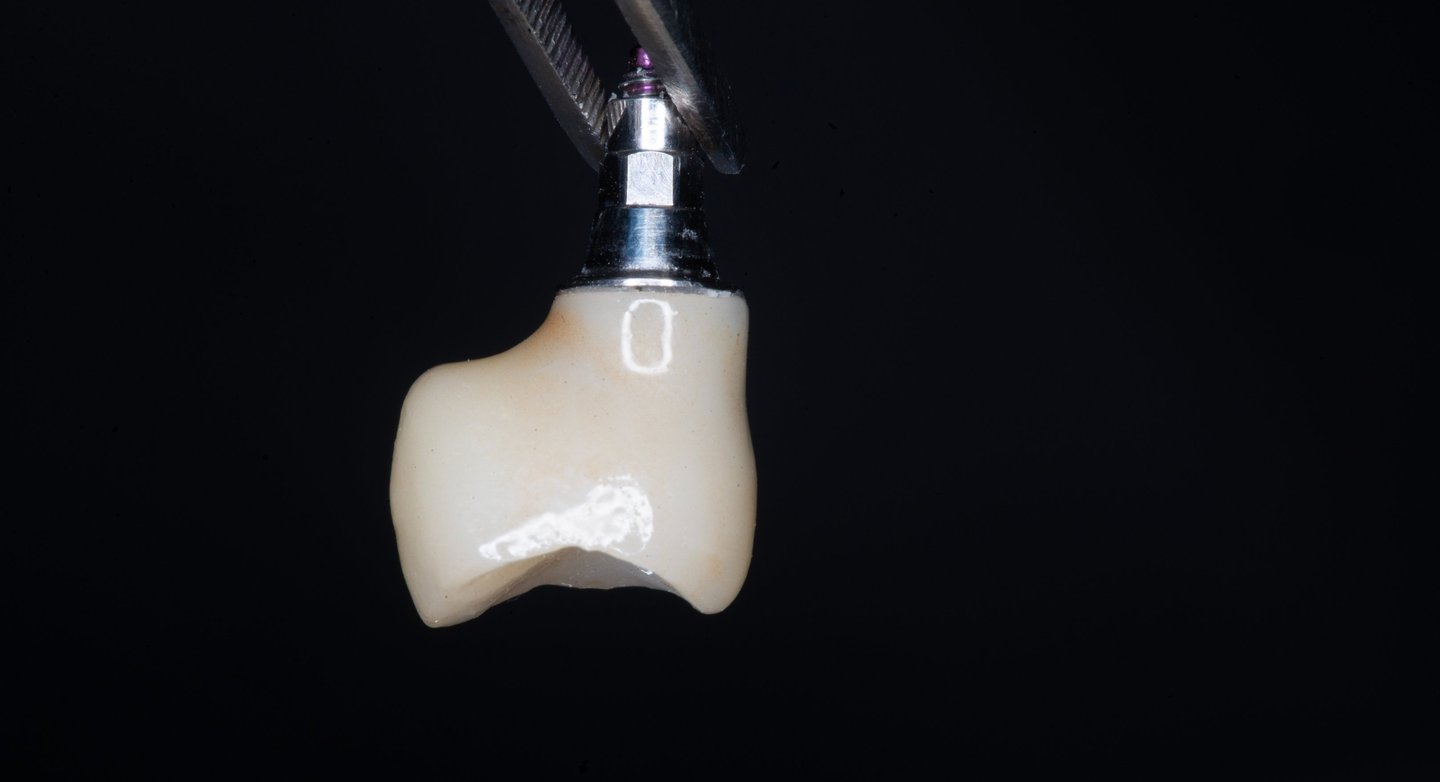 Tek diş eksikliğinde implant üstü zirkonyum protez