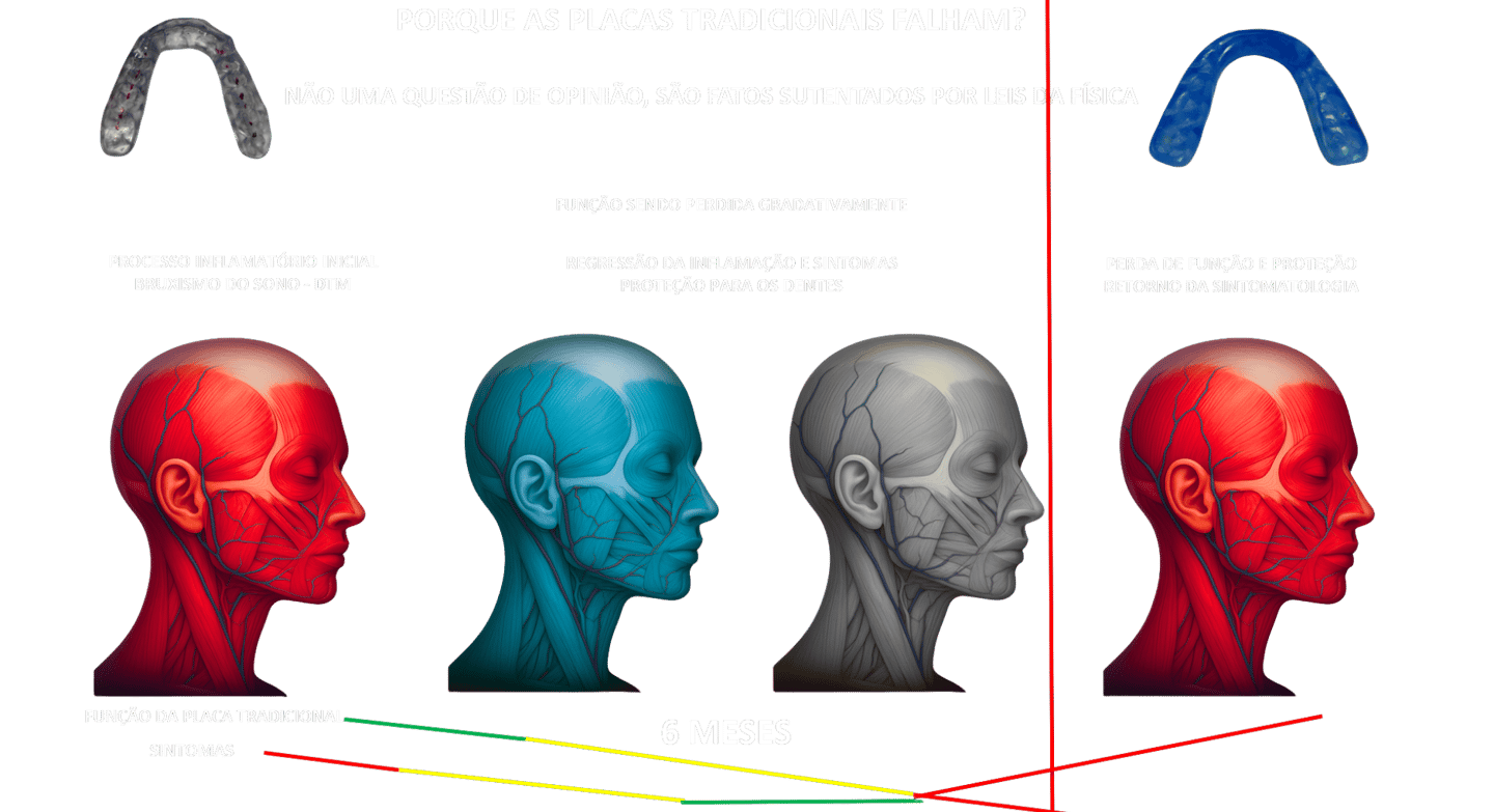 as melhores placas para bruxismo , placas Ortoscience, placas polyceram