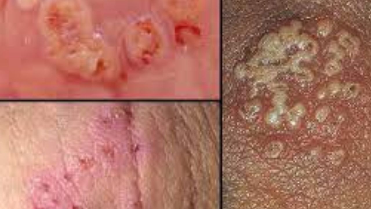 الهريس  التناسلى