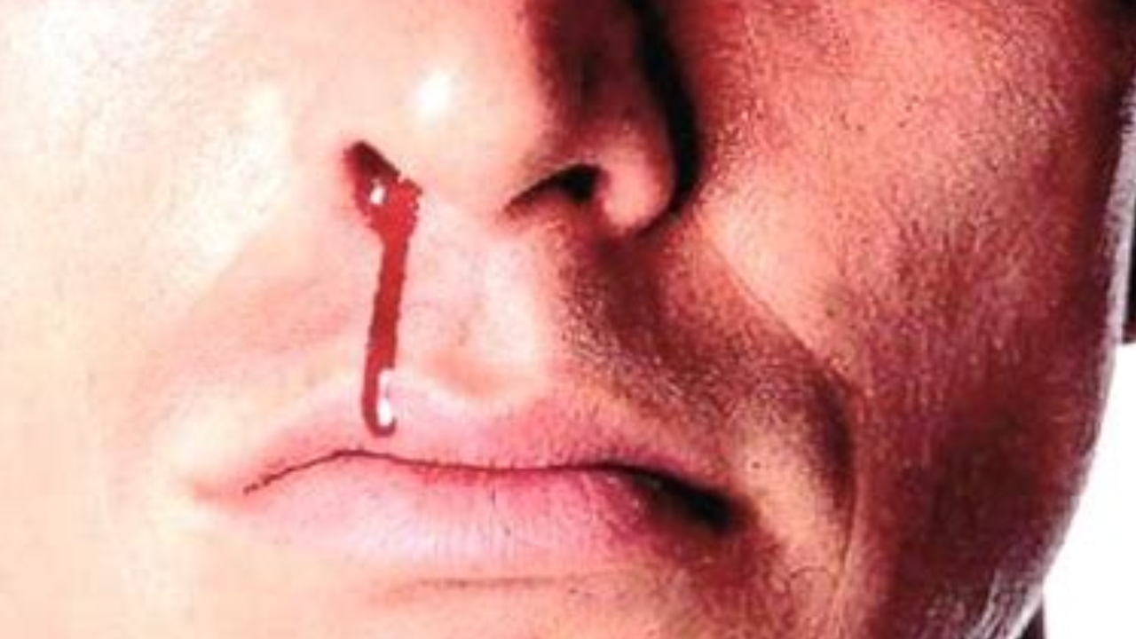 Epistaxis  Natural Remedi - fasting