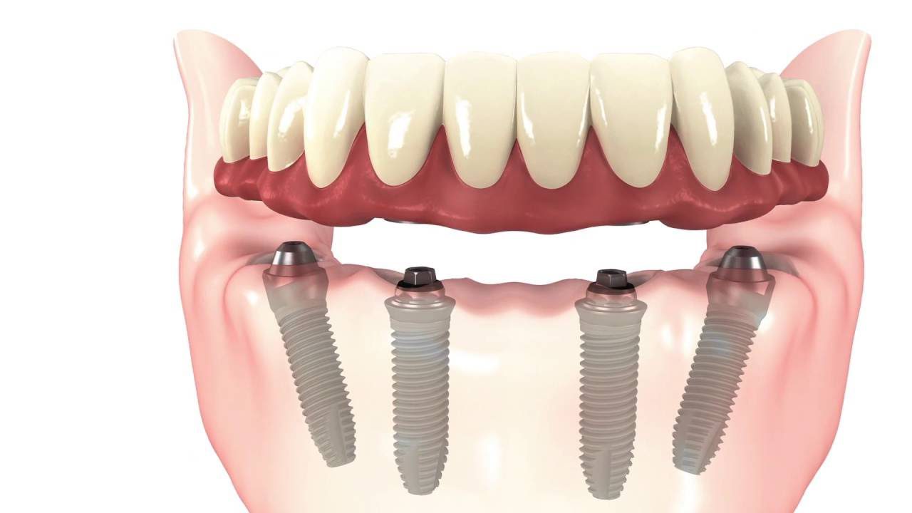 Get fix teeth with Dental Implants