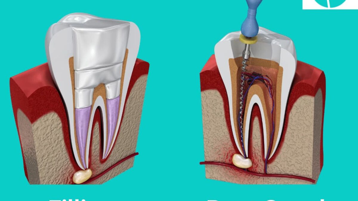 Root canal Treatment at dentosculpt