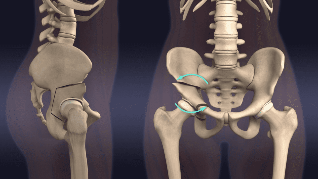 Osteotomia de Ganz, Berna, ou PAO.