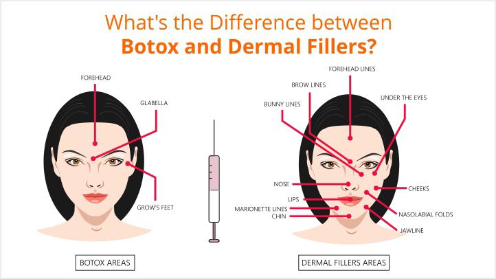 botox vs dermal fillers