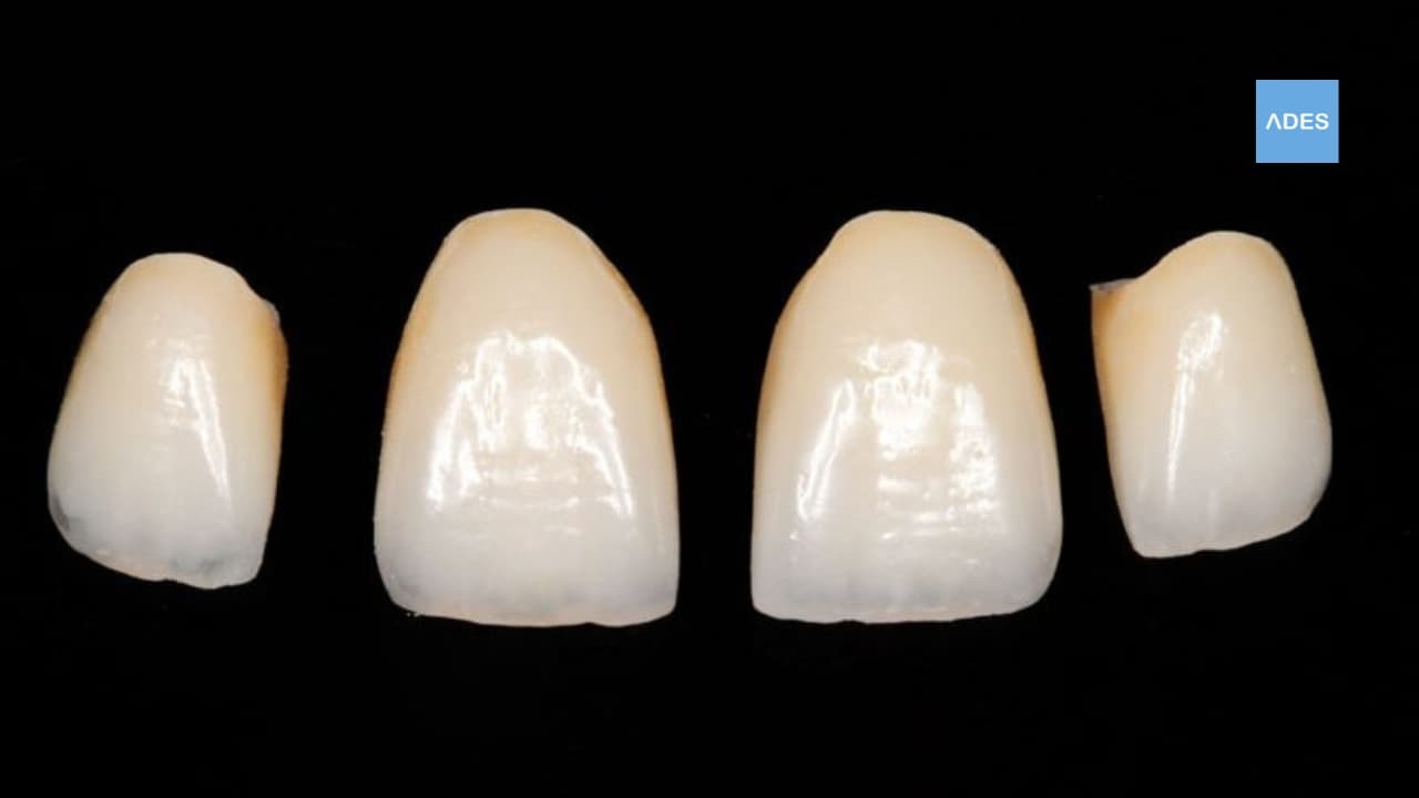 corona dental ceramica