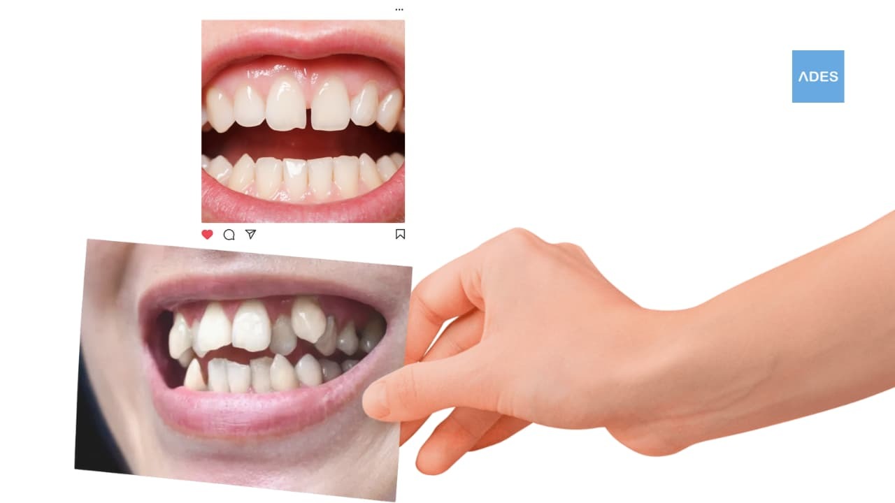 diastema vs apiñamiento