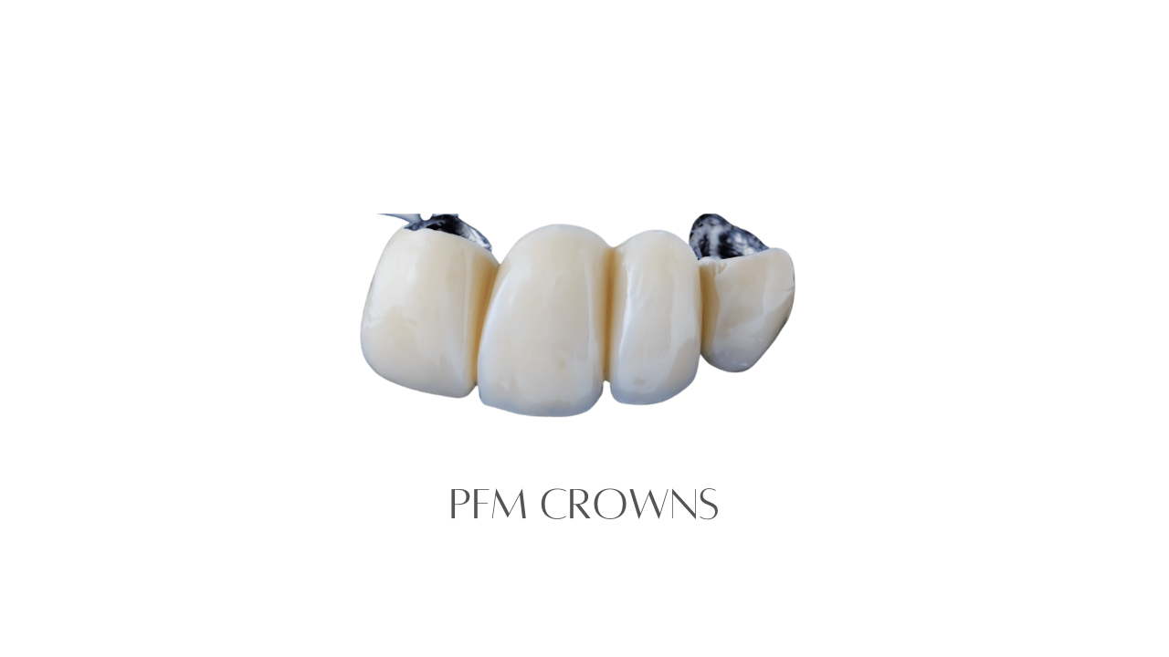 PFM Crowns