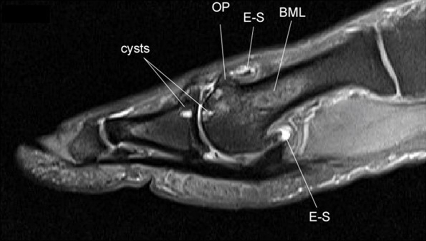 MRI slice of the first MTP joint showing labeled features: bone marrow lesions, cartilage loss and osteophytes