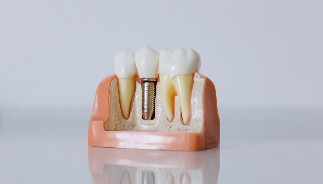 Tratamento de implantes dentários na Clínica do Convento, Setúbal – Recupera o teu sorriso.