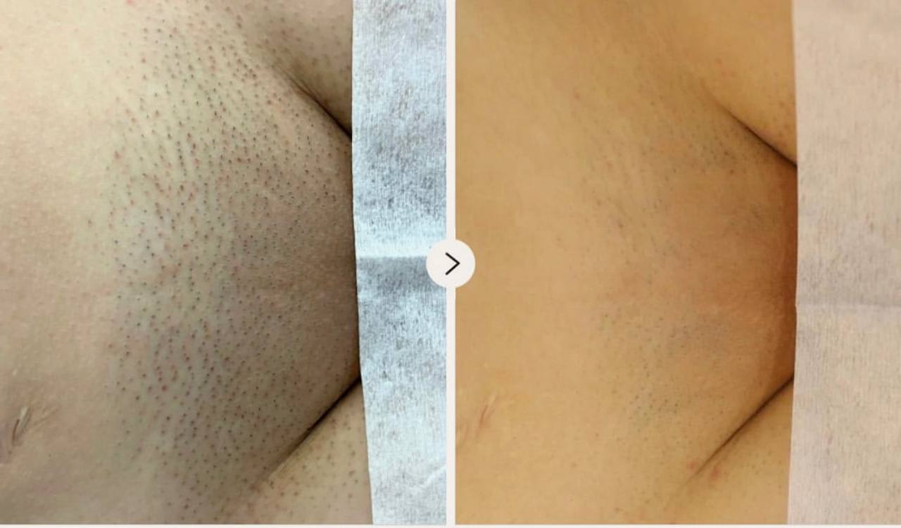 Depilacja laserowa Pruszków 