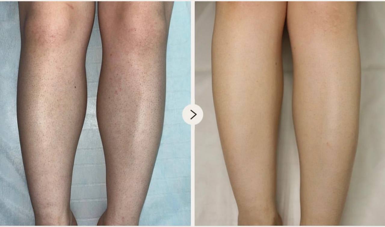 depilacja laserowa komorów