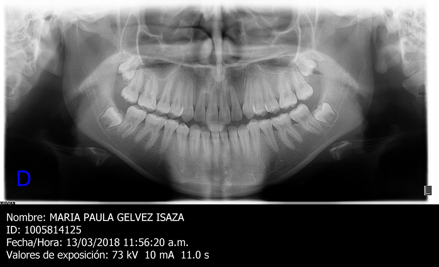 exodoncia de cordales cerca de mi
