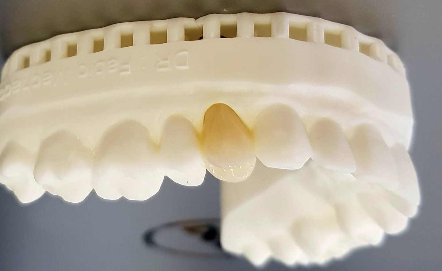 Moldura de dentes ilustrando implantes dentários realizados por dentista na Lapa PR.