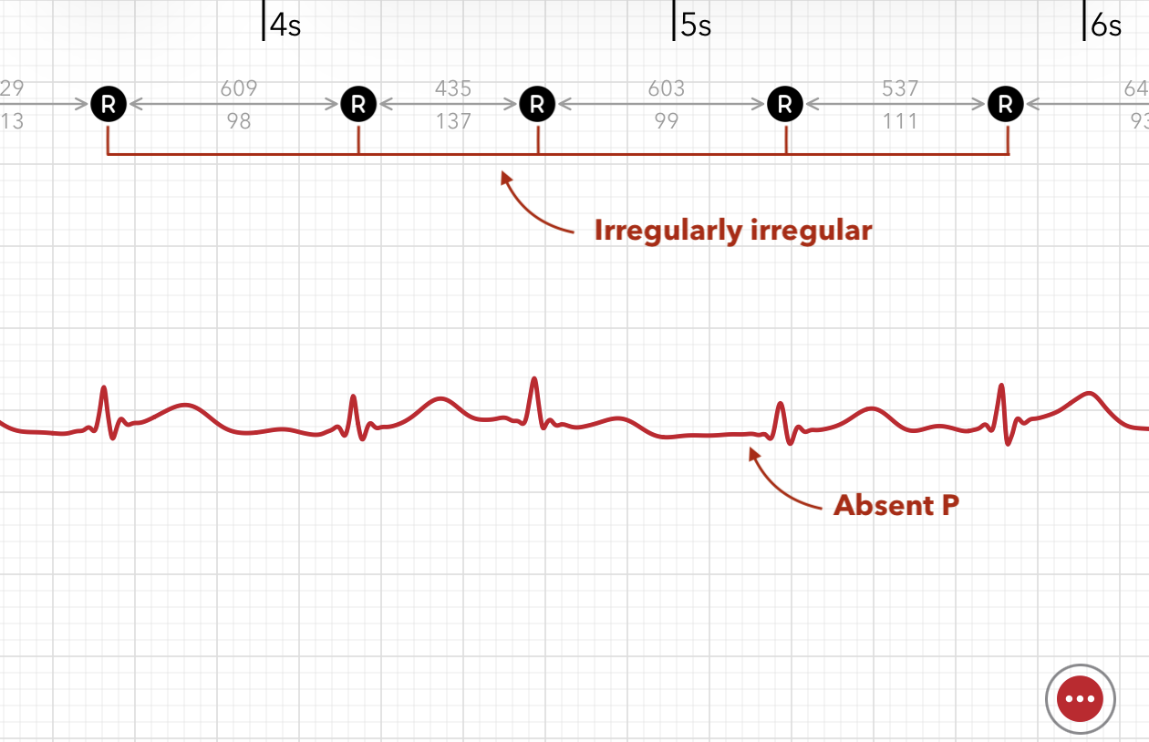 Atrial fibrillation is marked on Apple Watch ECG report showing Irregularly irregular beats