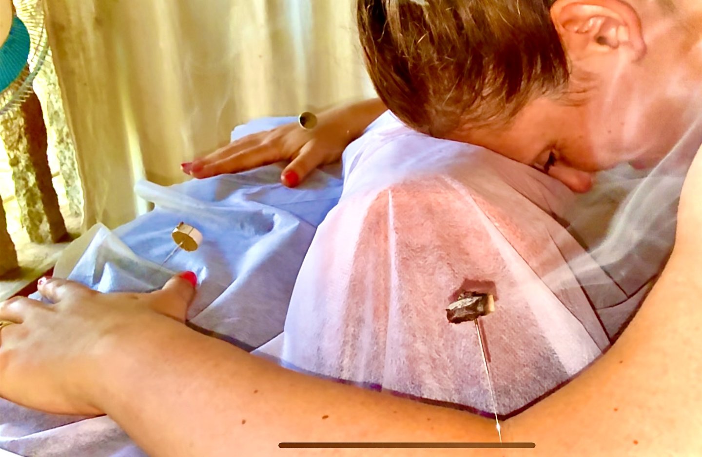 a picture of Alena Booth, founded of Grateful Minds doing acupunture in India