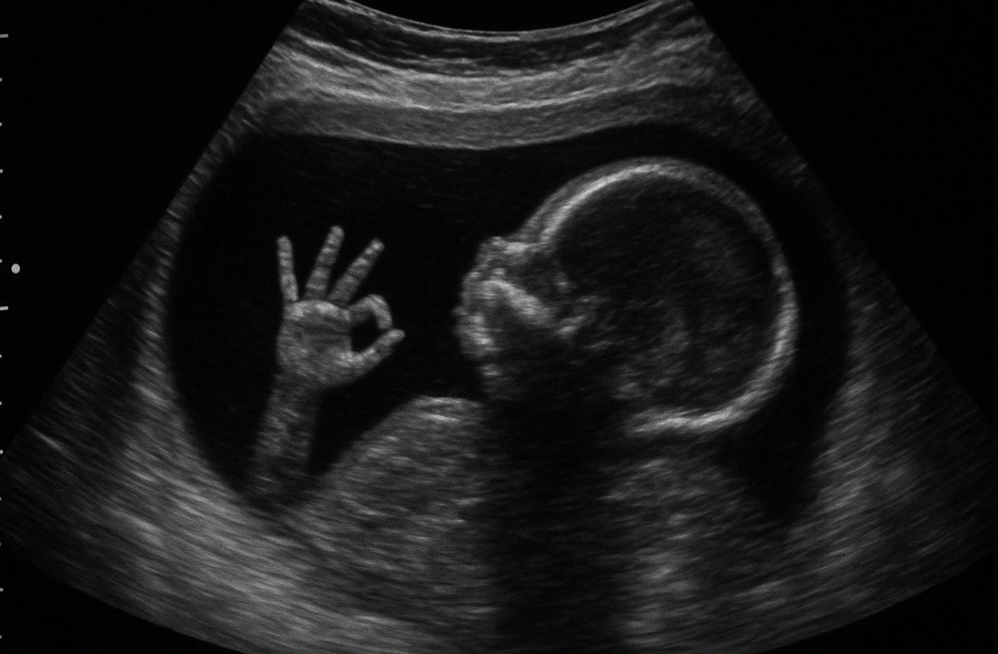 Illustration - journée mondiale du Spina Bifida et de l'hydrocéphalie.