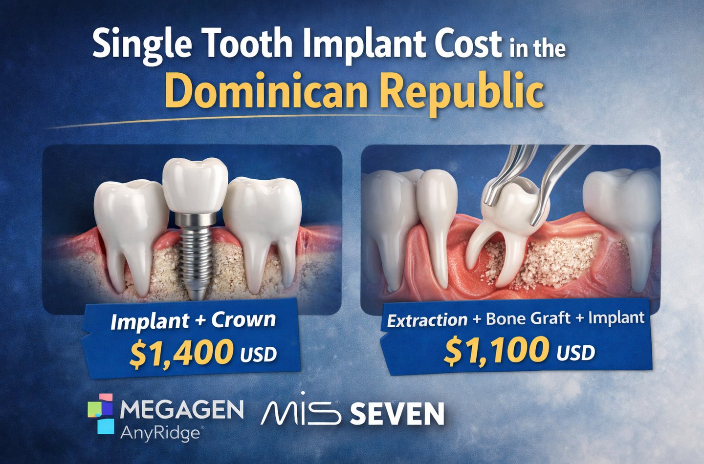 Single tooth implant cost in the Dominican Republic