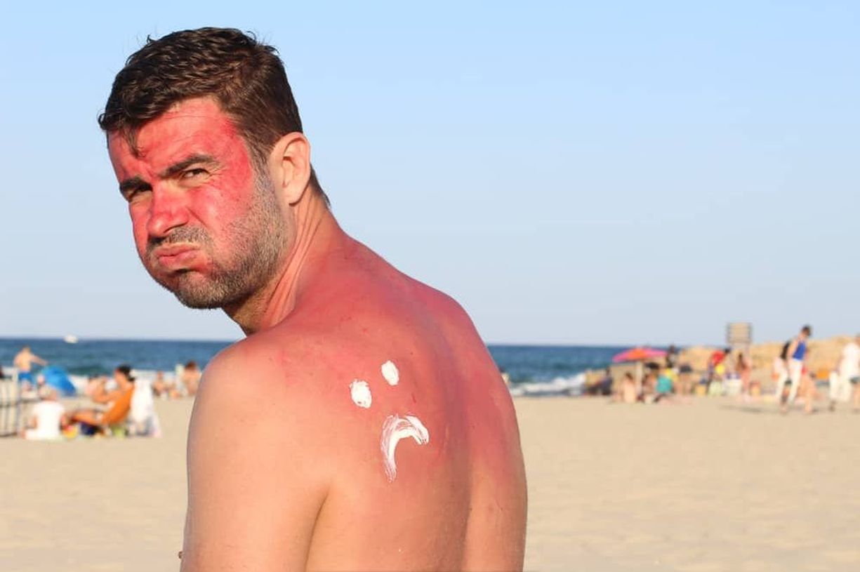 Dealing with Sunburns