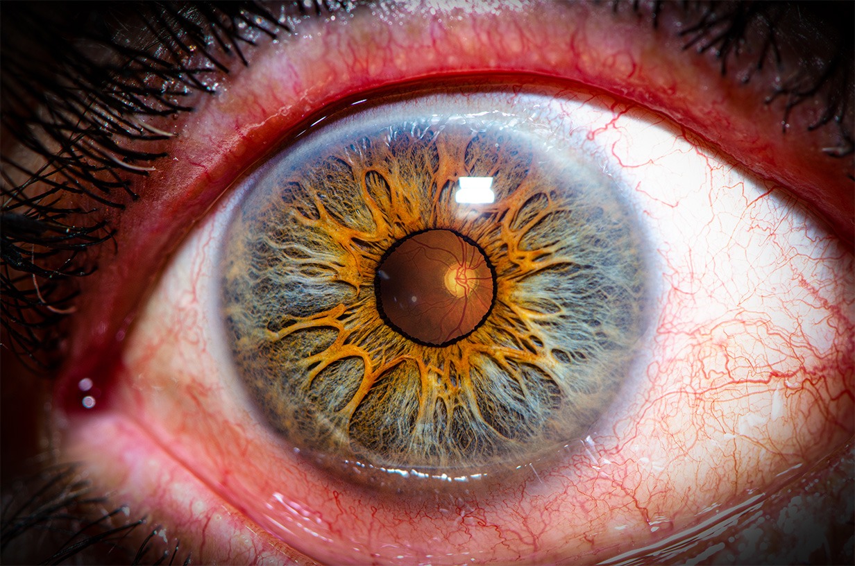 Foto de ojo con glaucoma