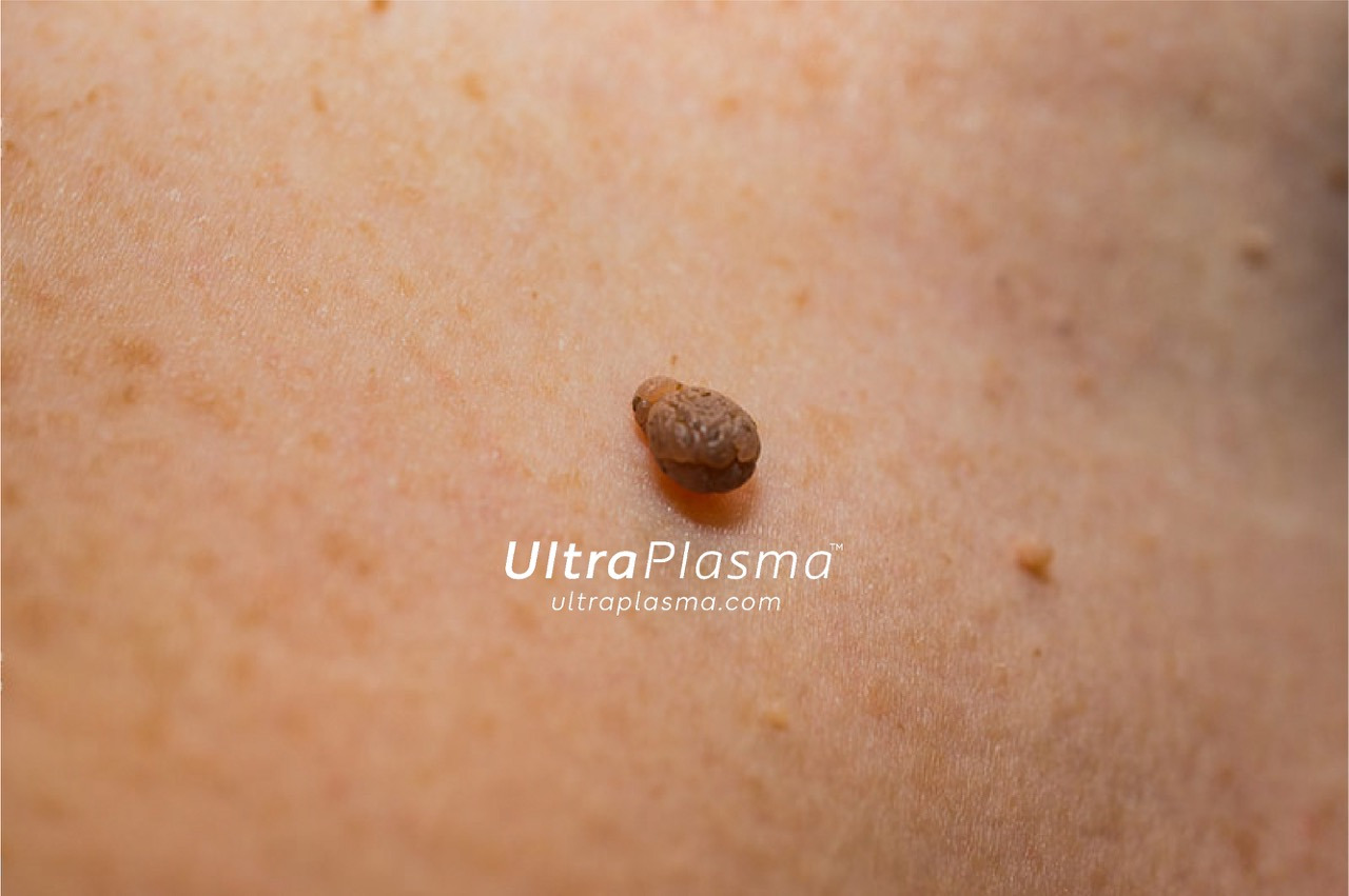ultraplasma.com_skin_tag_removal_treatment_et_beni_temizleme_silme_tedavi_ultra_plasma_ultra_plazma
