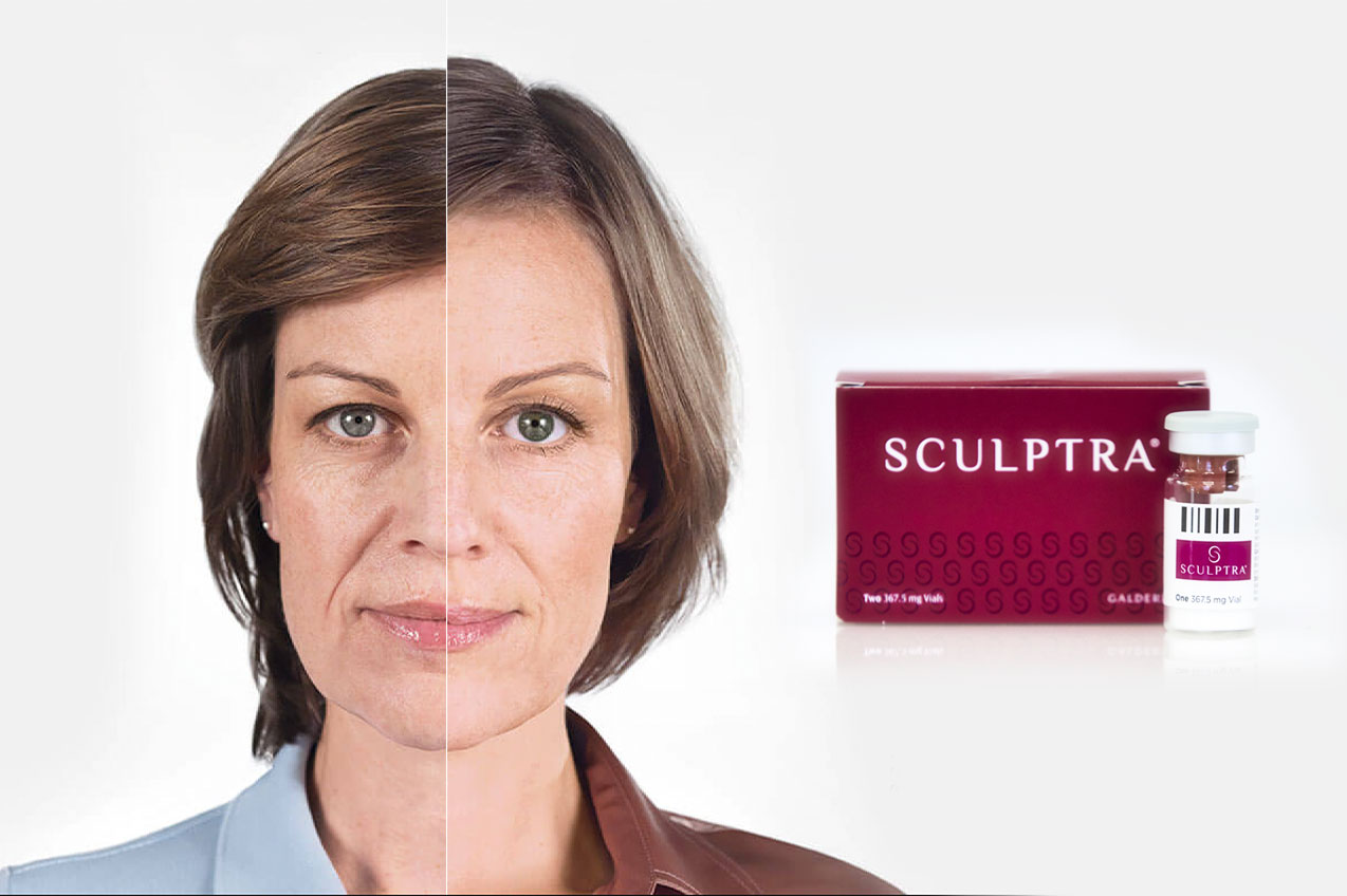 sculptra facial