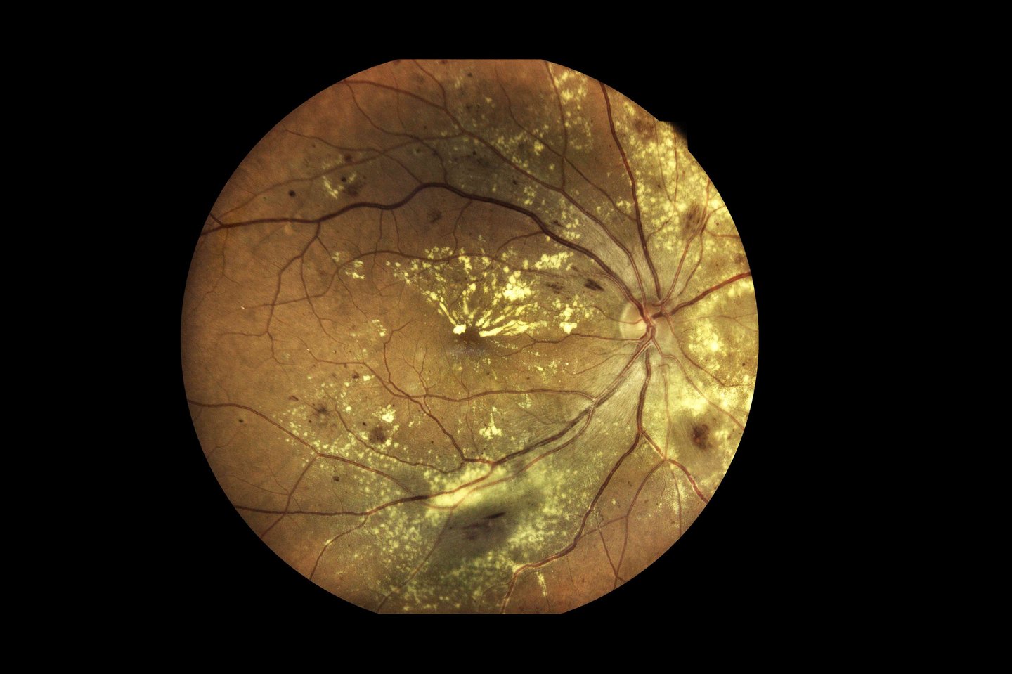 Diabetic Retinopathy