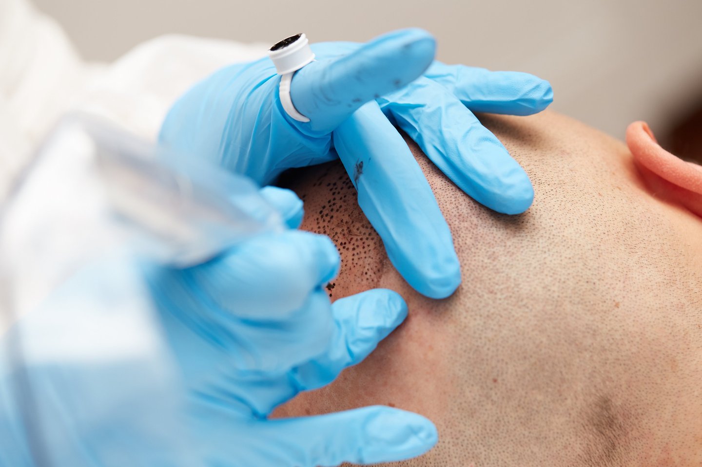 tricopigmentation et camouflage cicatrice en zone pileuse