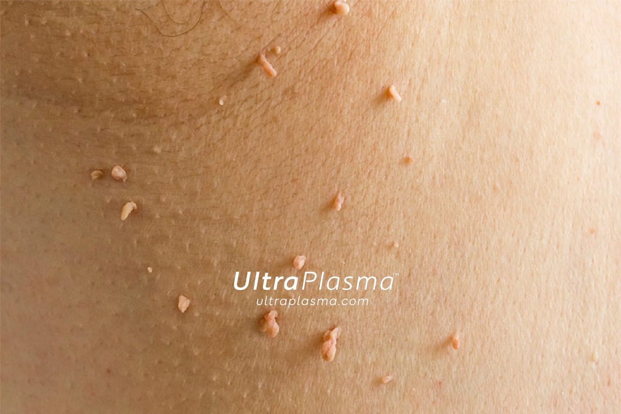 ultraplasma.com_skin_tag_removal_treatment_et_beni_temizleme_silme_tedavi_ultra_plasma_ultra_plazma2